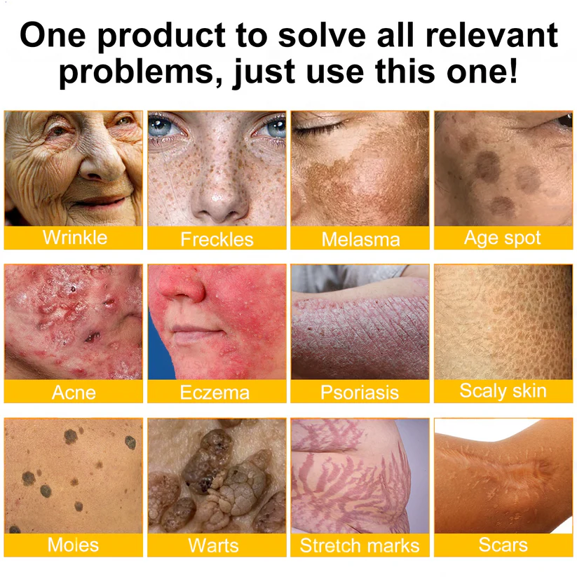 🔥Limited Time 60% OFF🔥🐝FDA Approved: Apithera™  Bee Venom Comprehensive Cream 🐝(Suitable for all ages & TGA recommends)