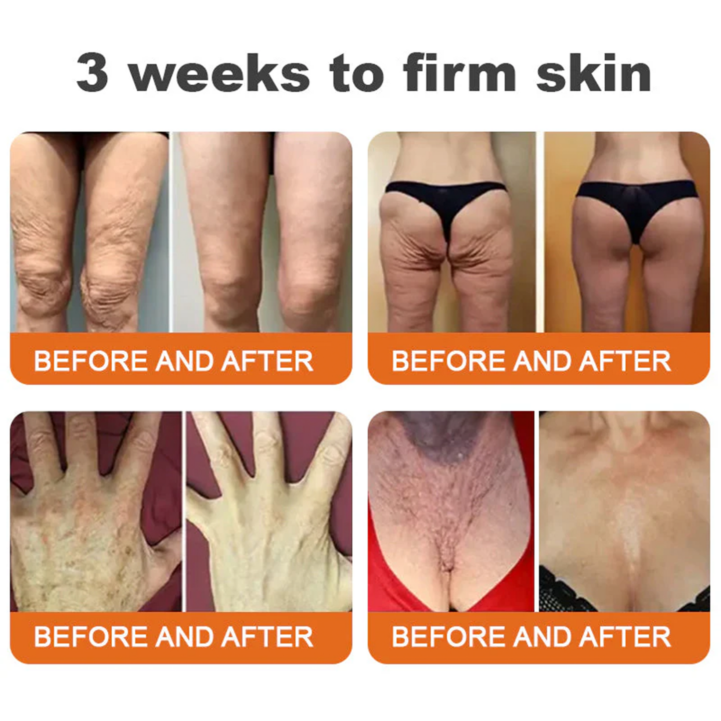 🔥Limited Time 60% OFF🔥🐝FDA Approved: Apithera™  Bee Venom Comprehensive Cream 🐝(Suitable for all ages & TGA recommends)